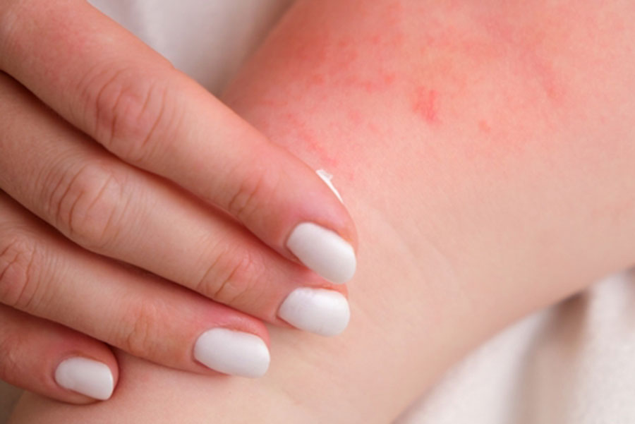 Quand la lessive attaque la peau personne qui touche sa peau irritée